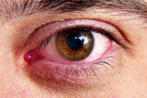 Red squirrel eyes, macro photo. Infection in the eye, bursting vessels of the eye.
